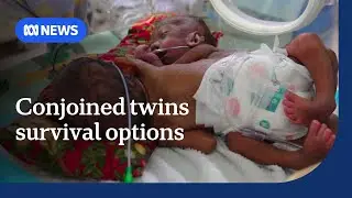 Australian doctors visit PNG conjoined twins to assess options | ABC NEWS