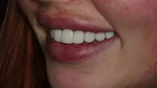 Amy Sargeant Same Day Smile Makeover by Kamran Rasul