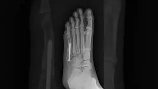 Progression of Jones fracture healing