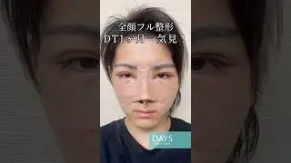 【全顔フル整形】ダウンタイム一気見！#shorts