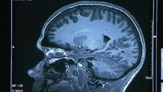Meningitis vaccine