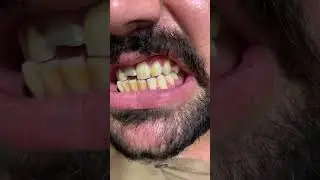 #dental #dentalissues #dentist #dentalart #dentalhealth #bridge #dentalproblems #pfm #dentistry