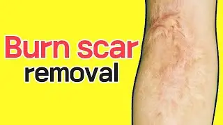In the spring, I treated a 29-year-old burn scar.