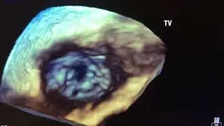 Rheumatic Tricuspid Stenosis: An Uncommon but Critical Diagnosis t