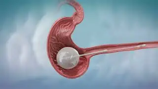 Spatz3 Implantation Procedure