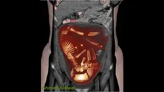 Pregnant CT & Fetal CT  3D by Synapse 3D