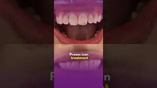 Icon treatment: Proses icon treatment #klinikgigiiman #dentist #icontreatment