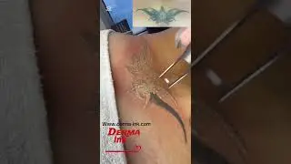 #dermainkdetatouageaulaser #tattoo #lasertato #lasertattooremoval #picosurelaser