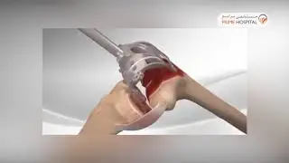 Prime Hospital - Knee Replacement Surgery