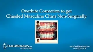 Overbite Correction to get Chiseled Masculine Chins Non-Surgically