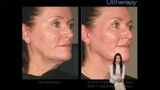 Skin Tightening In Staten Island Sofwave | Kalon Dermatology &ndash; Medical & Cosmetic Dermatology