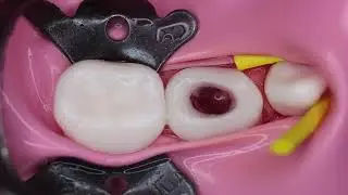 pulpotomy and pulpectomy 🔵  primary molar 🟠 mta pulpotomy 🟣 Now live streaming