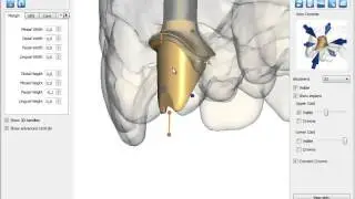 Atlantis&trade; abutments &ndash; Atlantis Editor | Dentsply Sirona