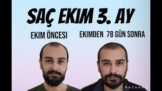 SAÇ EKİMİ 3. AY (SAÇLAR UZAMAYA BAŞLADI) - VİDEO 5