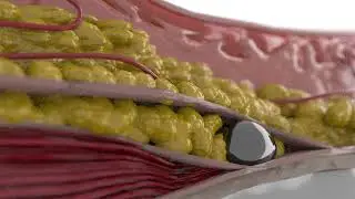 Moga Studio Srl 3D reconstruction & animation IBSA Dr Antonello Tateo Aliaxin SV chin