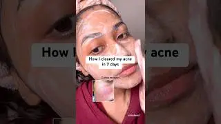Best face wash for clear skin | Foxtale Oil and Acne Control Face Wash #acne #fyp