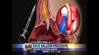 Balloon Sinus Dilation with Dr. Madan Kandula