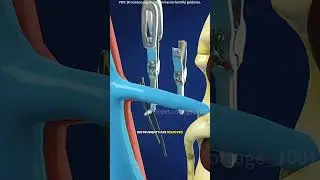 Robotic partial nephrectomy surgery (3D animation) #drone #theflash #space #automobile #robolution