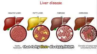Fatty Liver Secrets: What 99% Don't Know