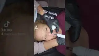 Nano Infusion Treatment - Lip Plump