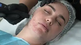 How can I get rid of acne using Cold Plasma Device: CoolJet