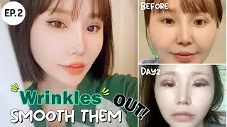 [SUB] Mongolian youtuber Grace Choi gets her eyelids smoothened! 3 months post-op