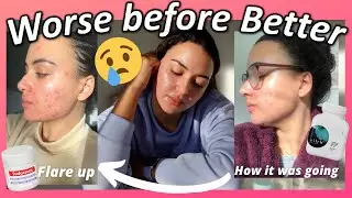 TRETINOIN 6 MONTHS | Before and After | Tretinoin 0.05% cream & Hydroquinone | Acne prone | Zilch 💊