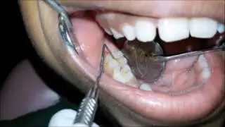 Indication, tooth preparation and application of Pit and Fissue Sealants