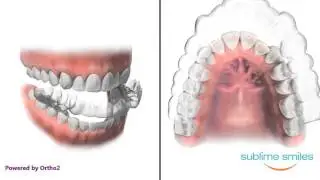Invisalign/Clear Removable Appliance