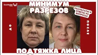 Irina Dream |ПЛАСТИЧЕСКАЯ ОПЕРАЦИЯ В КОРЕЕ 😱🏩🇰🇷 Docfinder Korea & тур по клинике BANOBAGI в Сеуле #3