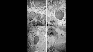 Occurrence of eosinophil extracellular trap cell death in COPD &ndash; Video abstract 115969