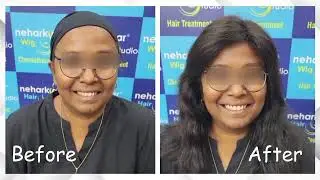Customized Cancer Wigs in Mumbai |Natural Hairline With Customized Cancer wigs  | Cancer Wigs