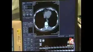 Optimal Diabetes Management Is Best Way to Avoid Heart Attacks
