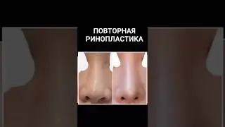 Повторная ринопластика ➡️  