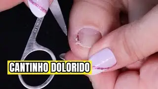 Como Faço as Unhas dos Pés com canto gordinho
