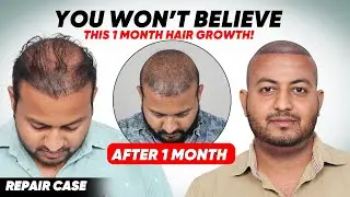 Best Hair Transplant in Hyderabad (HX-DXVD)| Best Results & Cost of Hair Transplant in Hyderabad