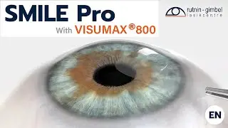 Treatment of Myopia, Hyperopia, and Astigmatism with SMILE Pro Technique / Rutnin-Gimbel LASIK