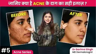 Kya Acne Scars Kabhi Theek Ho Sakte Hain? |  Acne scars kyu hote hain | Dermatologist
