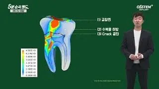 5 Minutes: Endodontics Analysis of Occlusal Force Transmission