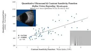 Vitrectomy Improves Visual Function in Multifocal Pseudophakia with Vision Degrading Myodesopsia