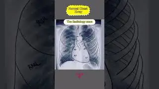 The Radiology # Normal # chest# x-ray