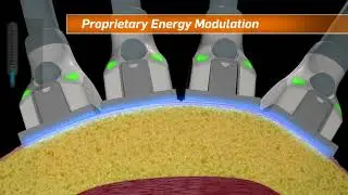 Sun Factory Tanning & Spa - How SculpSure Treatments Are Done