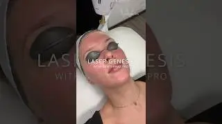 Laser Genesis Treatment with the GentleMax Pro - kills bacteria and safe for all skin types!