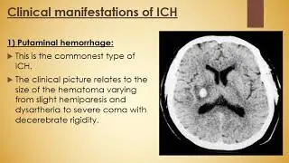 Hemorrhagic Stroke