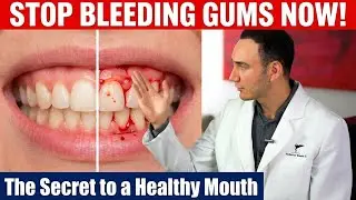 Gums Bleeding Even With Proper Oral Hygiene? This Video Is for You