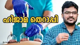 HIJAMA THERAPY | ഹിജാമ തെറാപ്പി | DR ANEES UNANI
