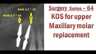 Compression screws dental implant for upper maxillary molar replacement