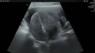 Percuatneous Microwave Ablation and Endometrium Ablation for Uterine Adenomyosis