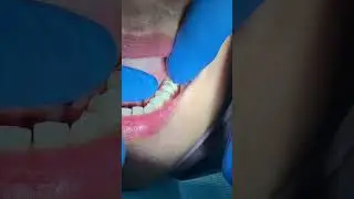 Flexible denture