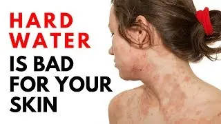 Hard Water on Skin